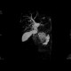 Adenocarcinoma of biliary duct: MRI - Magnetic Resonance Imaging